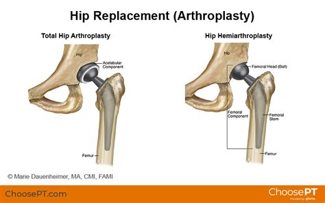 Total Hip Replacement .